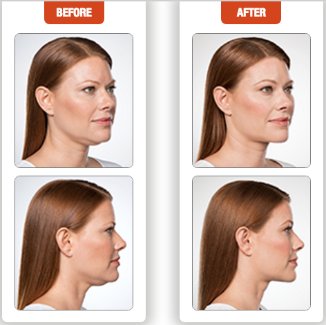 Screen-Shot-2016-05-27-at-11.14.47-AM Kybella Dallas Plastic Surgeon