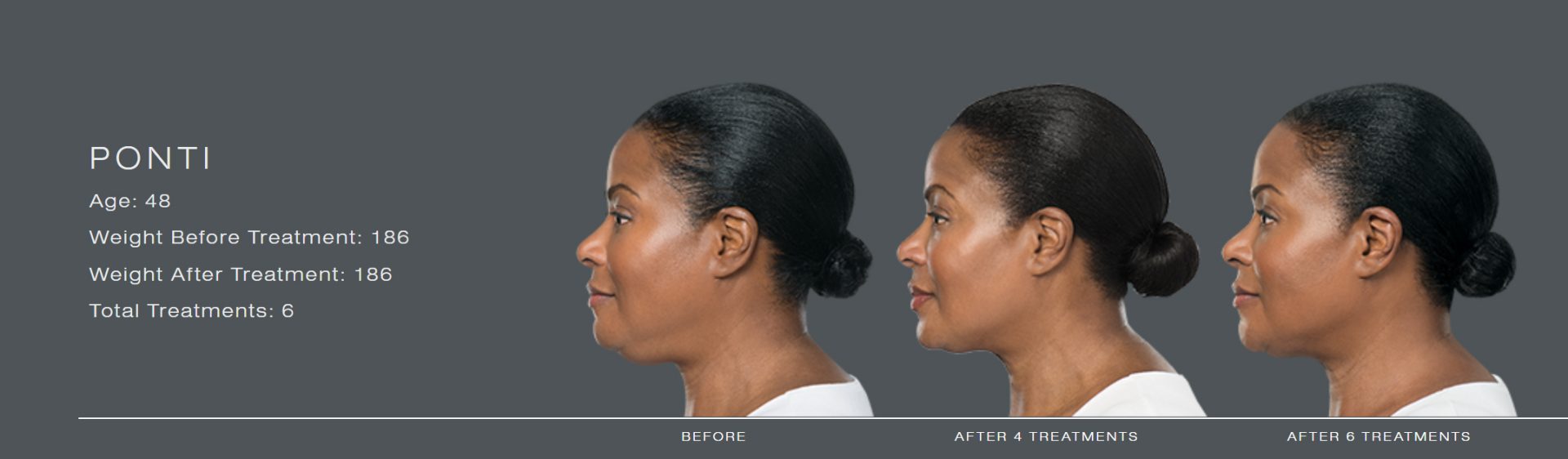 Kybella Injections for Chin Fat Reduction Before and After Photos