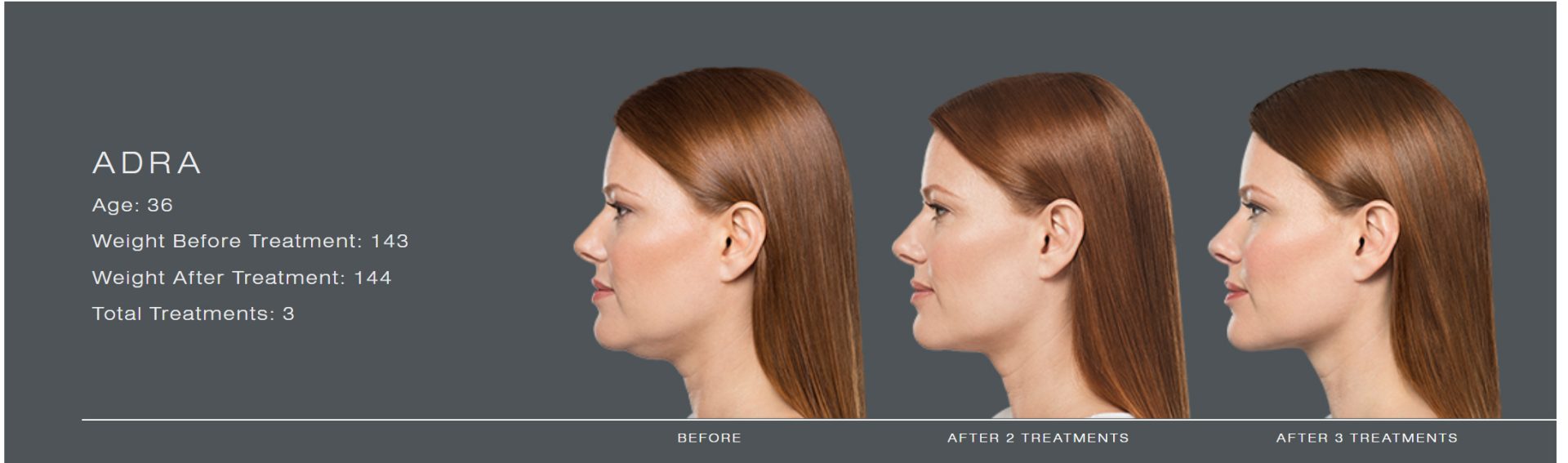 Kybella Injections for Chin Fat Reduction