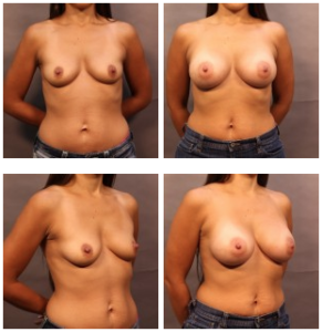 24 Hour Recovery® Breast Augmentation