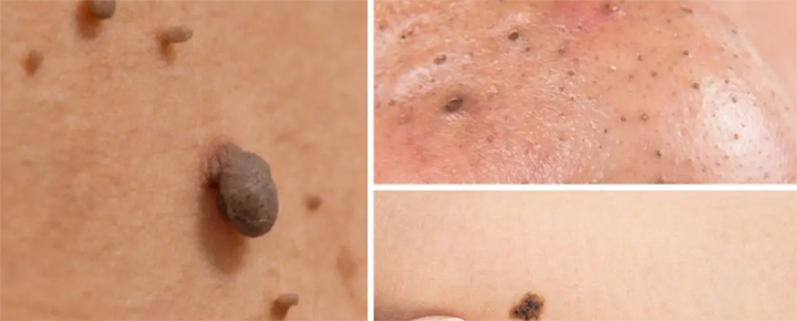 Off mole shaving at home a DIY Don’ts: