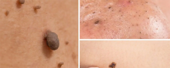 Mole a shaving home off at Removing Moles