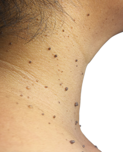 Mole / Skin Tag Removal 