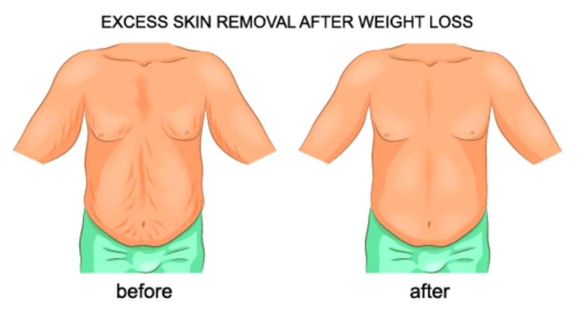 Skin Removal Surgery After Weight Loss
