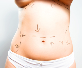 Tummy Tuck Plastic Surgery