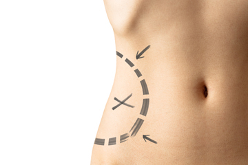 Are You a Candidate For Tummy Tuck Plastic Surgery?