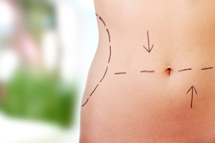 What To Expect During Tummy Tuck Plastic Surgery?