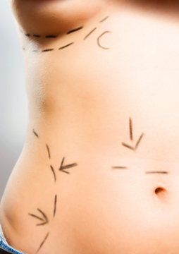 Best Questions To Ask Before Tummy Tuck Plastic Surgery