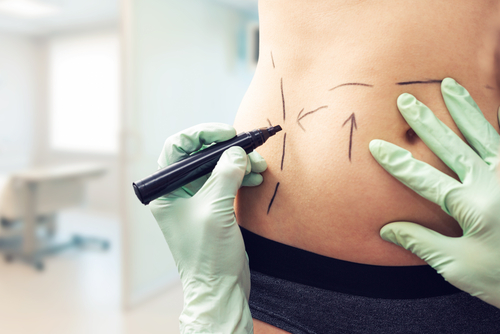 What Questions Should You Ask Your Surgeon About Tummy Tuck Surgery?