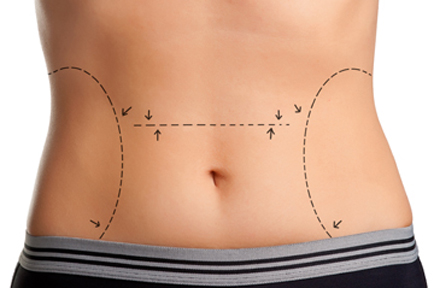 Tummy Tuck Plastic Surgery Procedure Steps