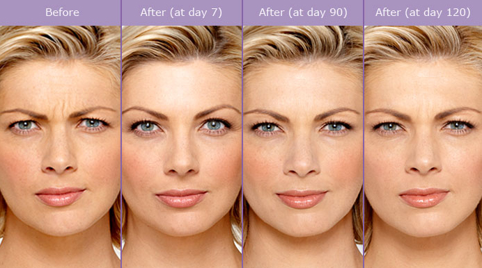 Botox Procedure Steps