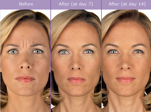 What Should You Expect During A Consultation For Botox Injections?