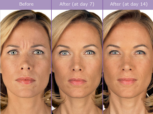 Botox Injectables