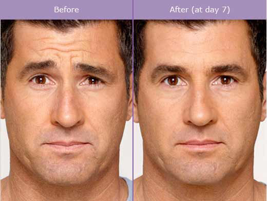Botox Helps Remove Wrinkles