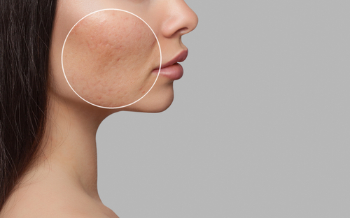 Laser Skin Resurfacing To Get Rid Of Hyperpigmentation