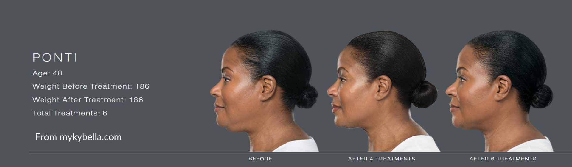 Kybella