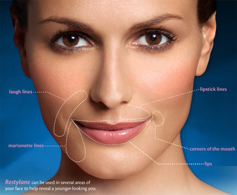 How Much Does Restylane Dermal Filler Cost?
